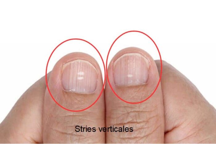 Ongles striés verticalement