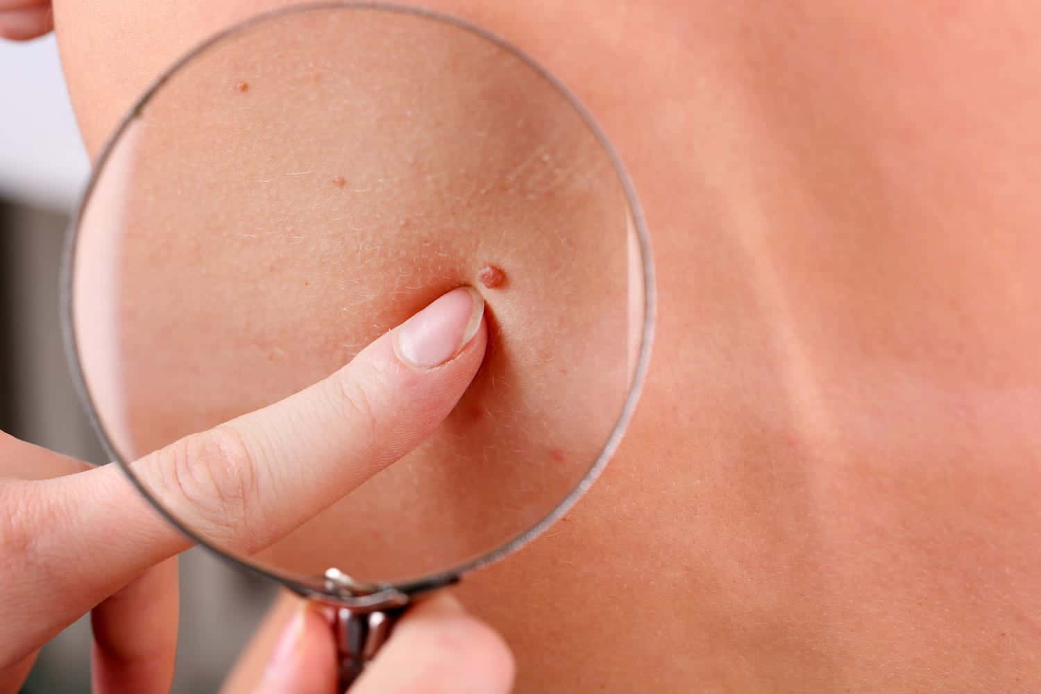 Grain de beauté sur la peau