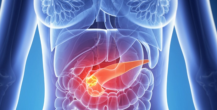 Schéma cancer pancréas