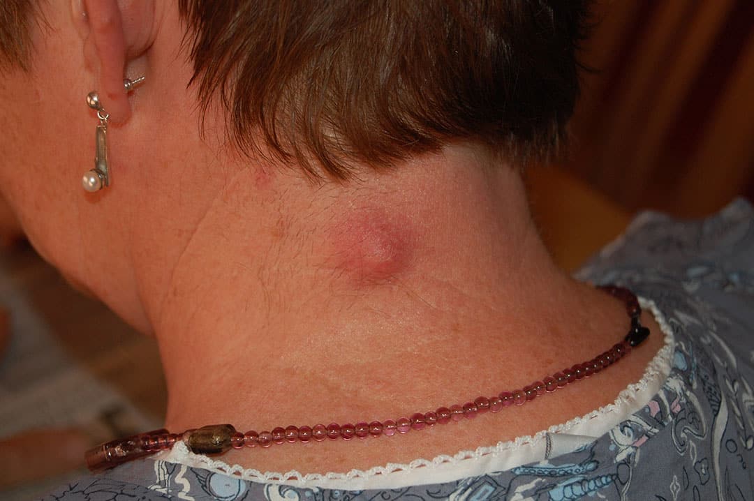 Kyste inflammatoire visible sur la peau