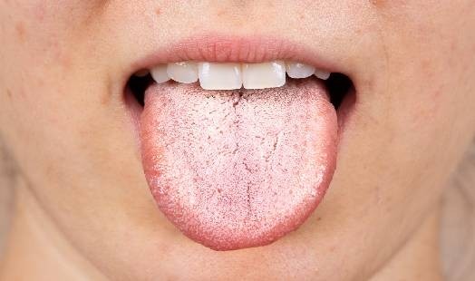 Langue recouverte d'un dépôt blanchâtre