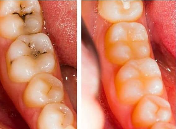 Alimentation saine pour des dents solides