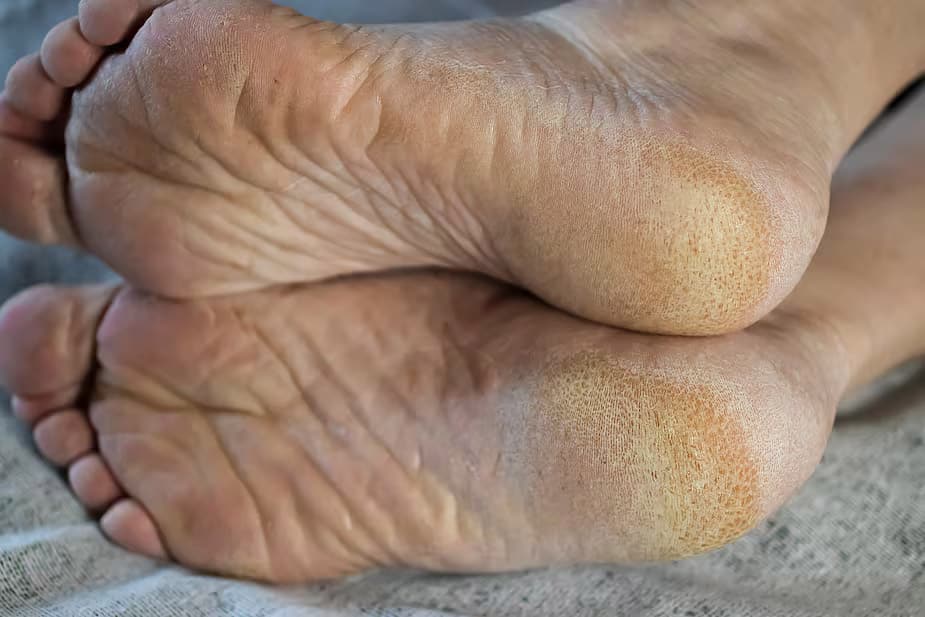 Pieds présentant une coloration jaunâtre