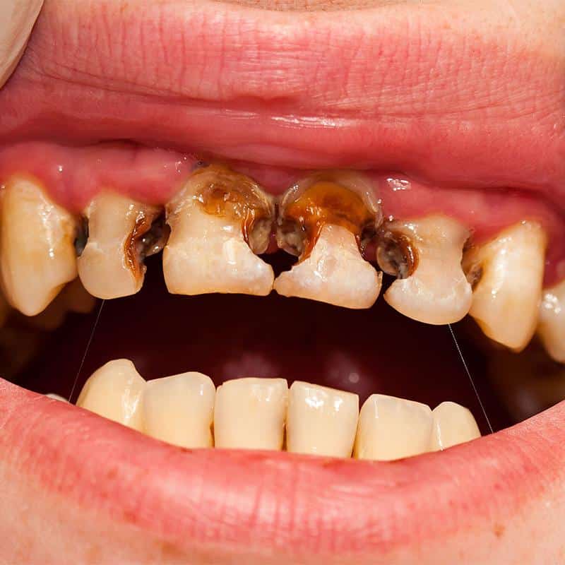 Dents abîmées par les sodas