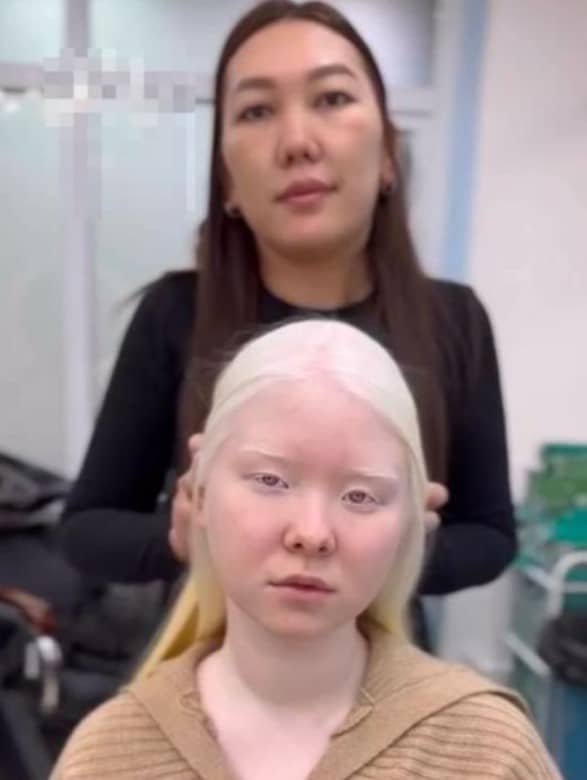 Personne albinos avec cheveux bruns