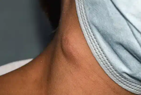 Ganglion lymphatique enflé dans le cou