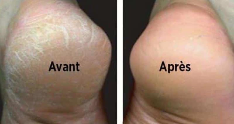 Pieds bien hydratés après traitement naturel