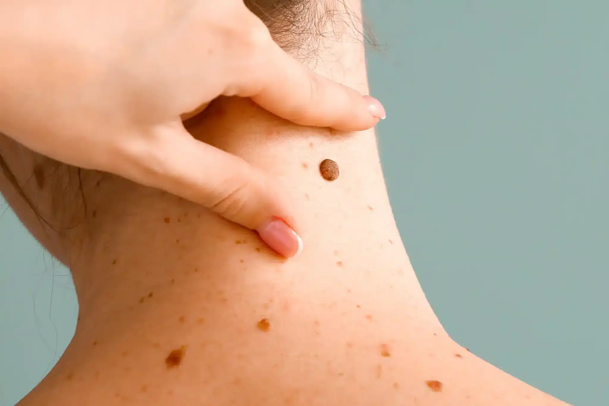 Examen d'un grain de beauté