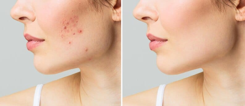 Comparaison avant/après masque maison