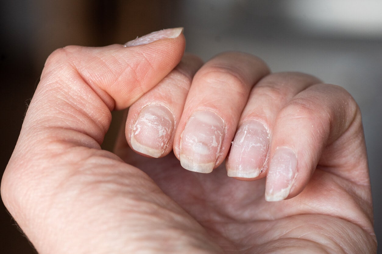 Ongles bosselés et ondulés