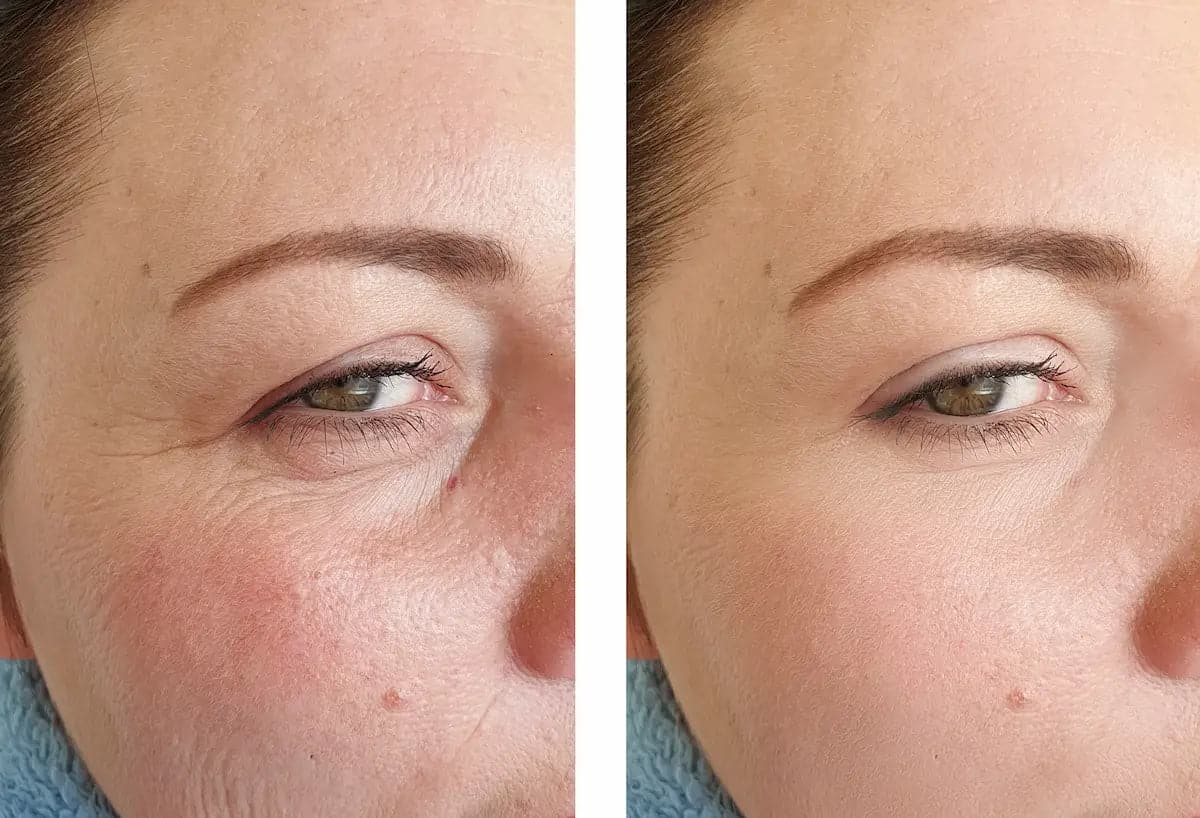 Comparaison avant/après soin de la peau