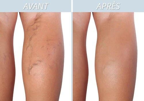 Femme massant ses jambes pour soulager les varices