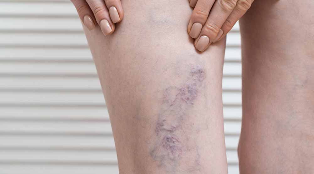 Jambes présentant des varices