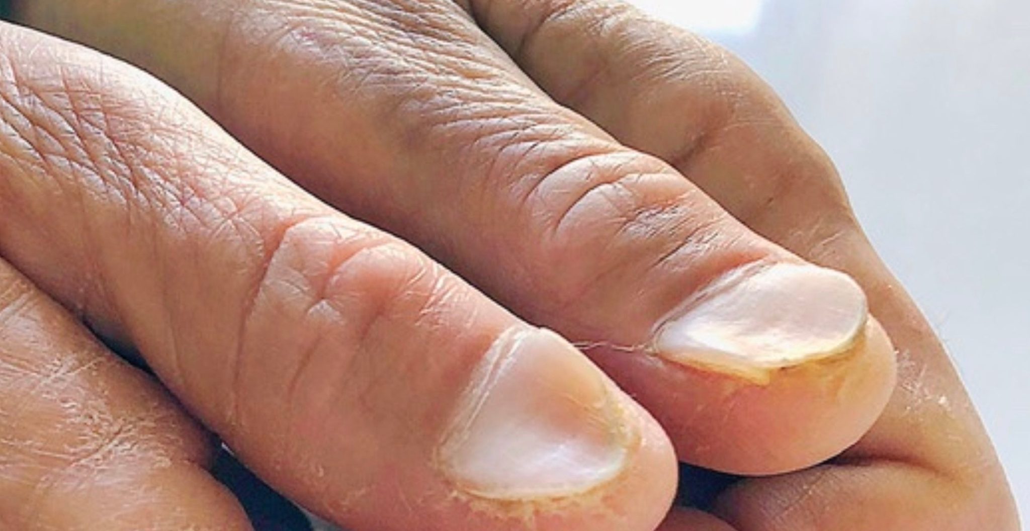 Ongles en cuillère