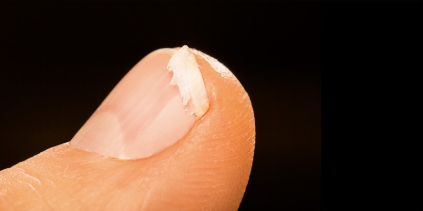 Ongles cassants