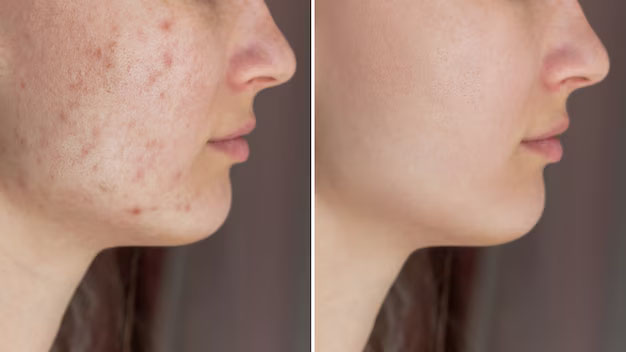 Transformation d'une peau à problèmes après soins naturels