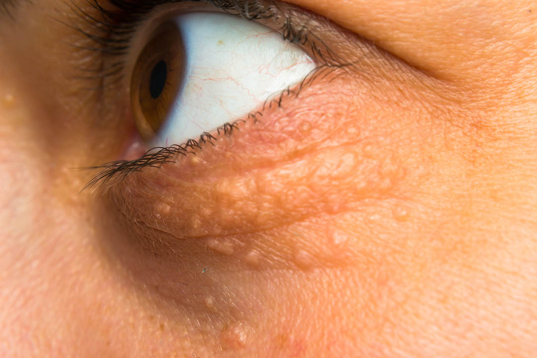 Détail d'un xanthélasma sur la paupière d'une femme