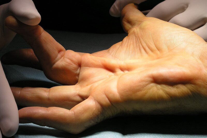 Main présentant des signes de syndrome du canal carpien