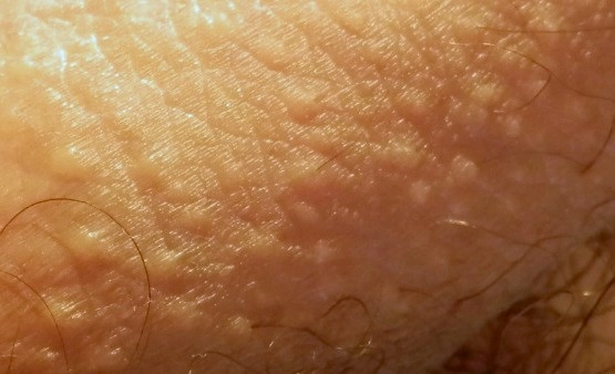 Exemple de grains de Fordyce sur la lèvre