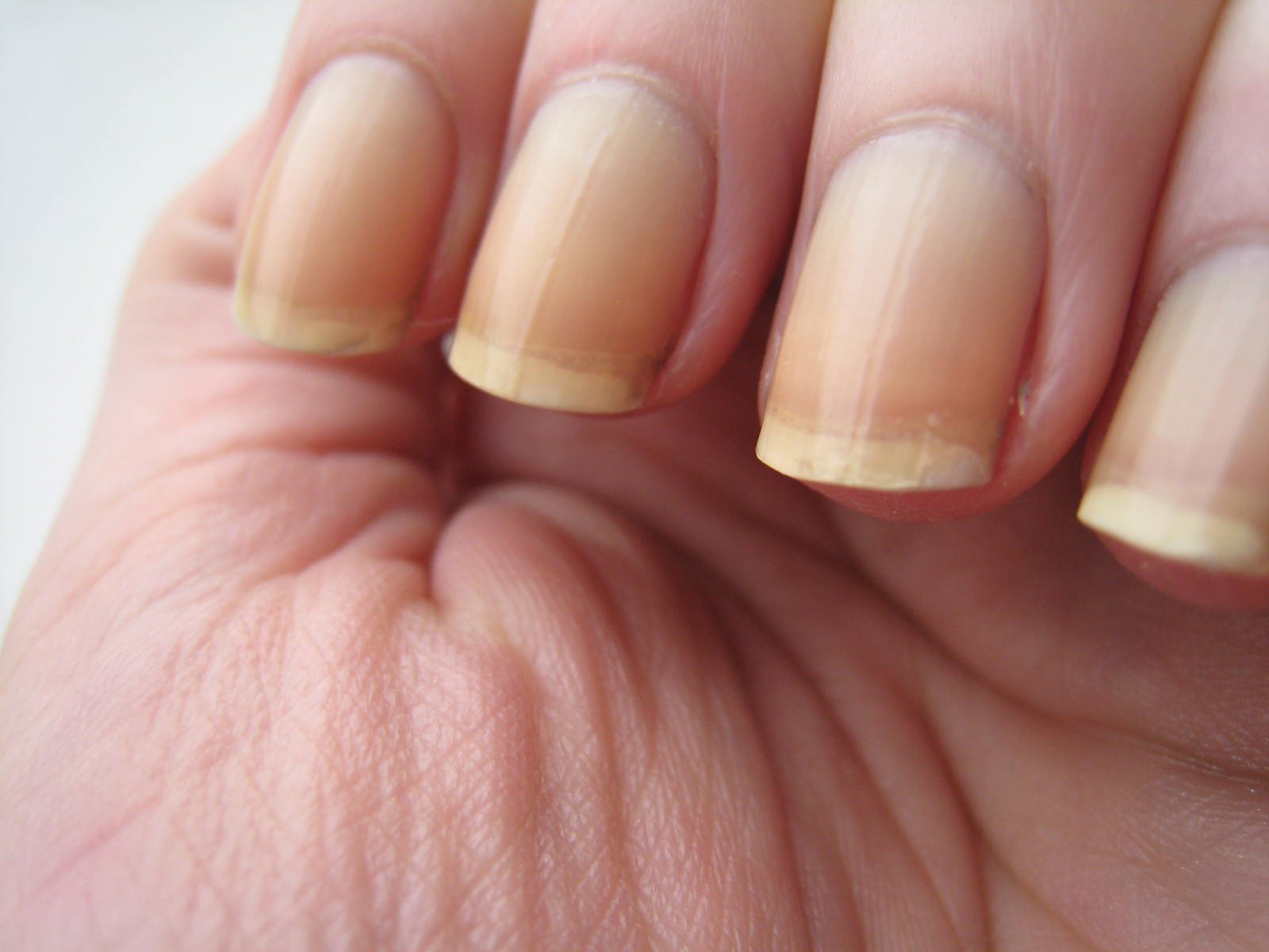 Ongles jaunes et cassants