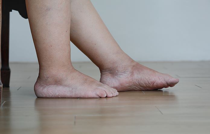 Pied enflé nécessitant des soins