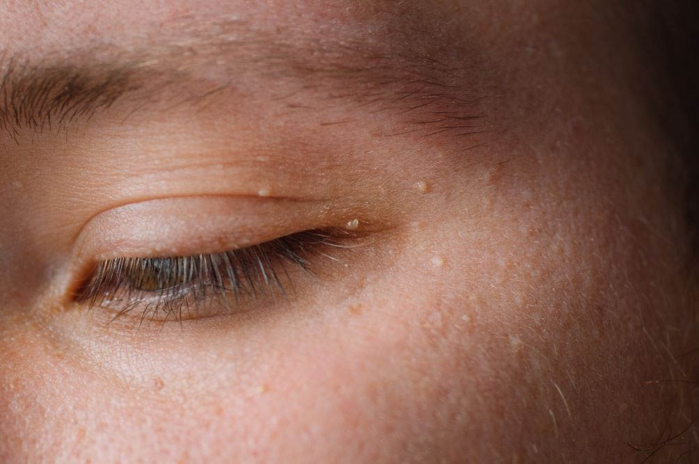 Consultation dermatologique sur les miliums