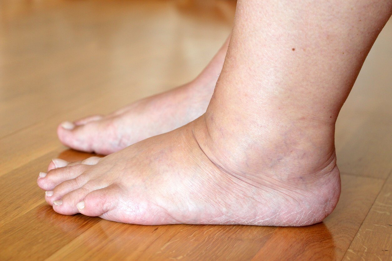 Illustration montrant des jambes gonflées