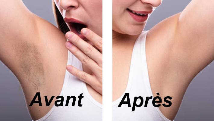 Recette naturelle pour éclaircir les aisselles