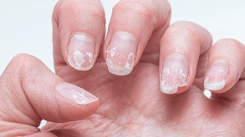 Ongles fragilisés montrant des signes de dédoublement