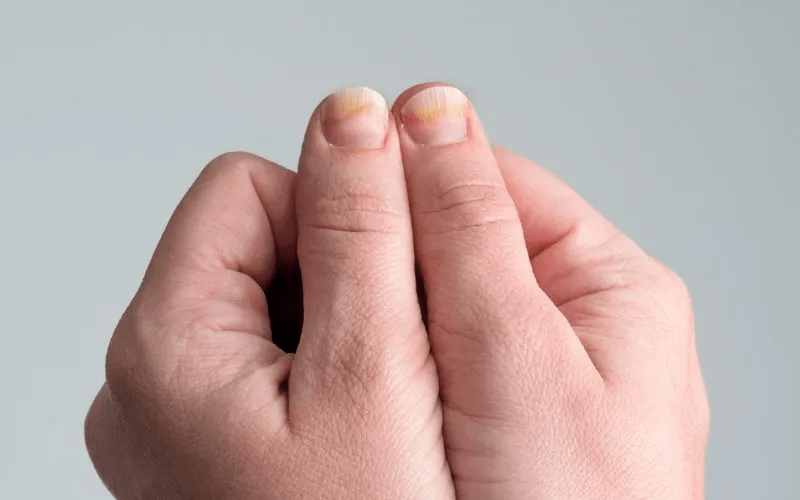 Ongles présentant une concavité caractéristique