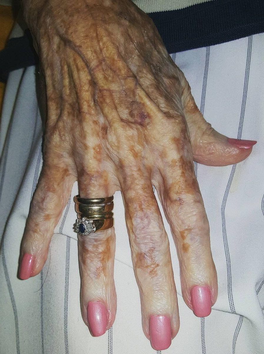 Main d'une personne âgée recevant un soin esthétique