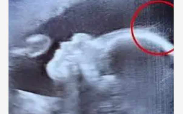 Échographie montrant un fœtus avec une chevelure visible