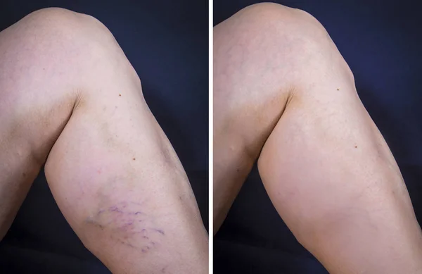 Gros plan sur une jambe présentant des varices